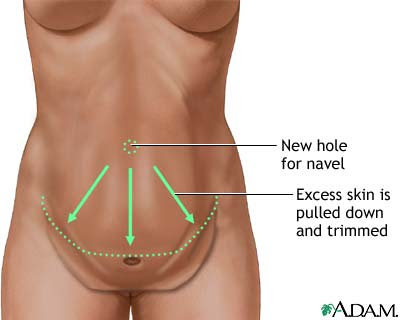 tummy tuck scars. Abdominoplasty (Tummy Tuck)