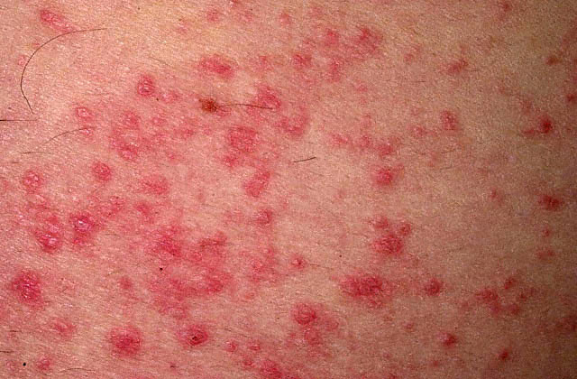 may be aggravated by heat, heat rash on baby skin_17. may be aggravated by heat,