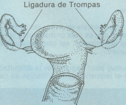 Salpingoclasia La Salpingoclasia