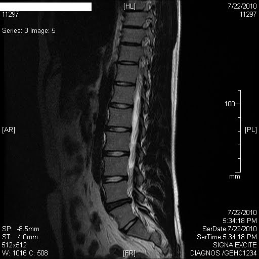 mri results disc degenerative herniated lumbar medical
