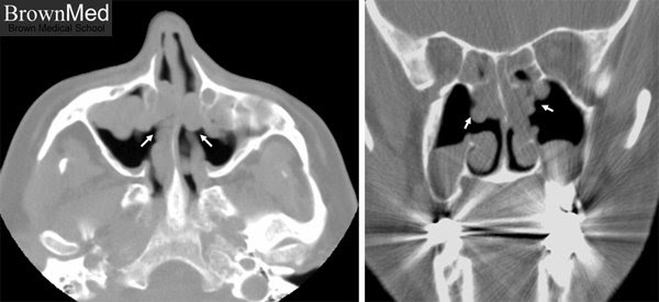 do nasal polyps show on ct scan