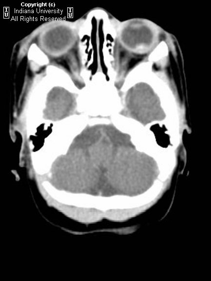 Coats Disease Ct