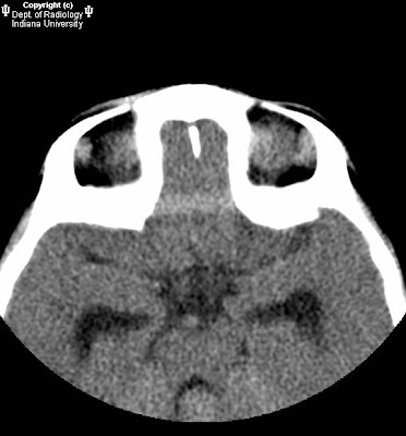 Fourth ventricular ependymoma with foramen of Luschka & Magendie extension