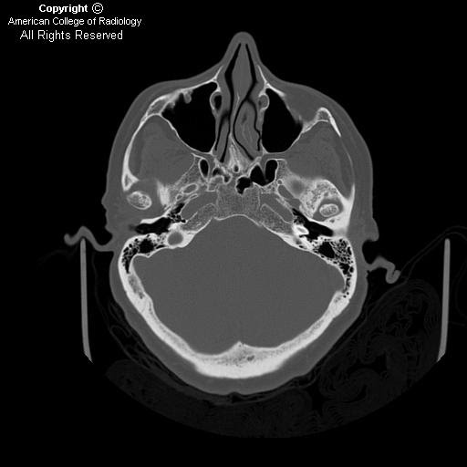 Neuroradiology On the Net Superior semicircular canal dehiscence