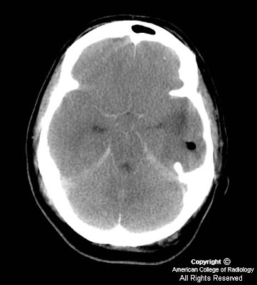Ct+scan+of+brain+abscess