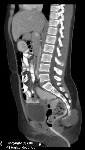 Neuroradiology On the Net: Extra spinal ependymoma at level of coccyx