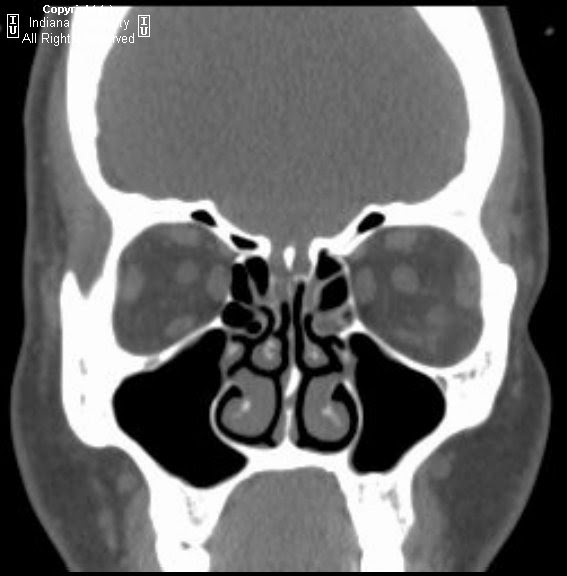 ct myelography csf leak