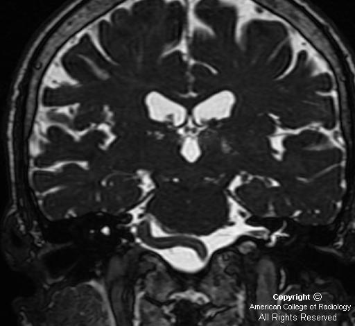 Matchless Compressed facial nerve situation familiar Can not Compressed facial nerve accept