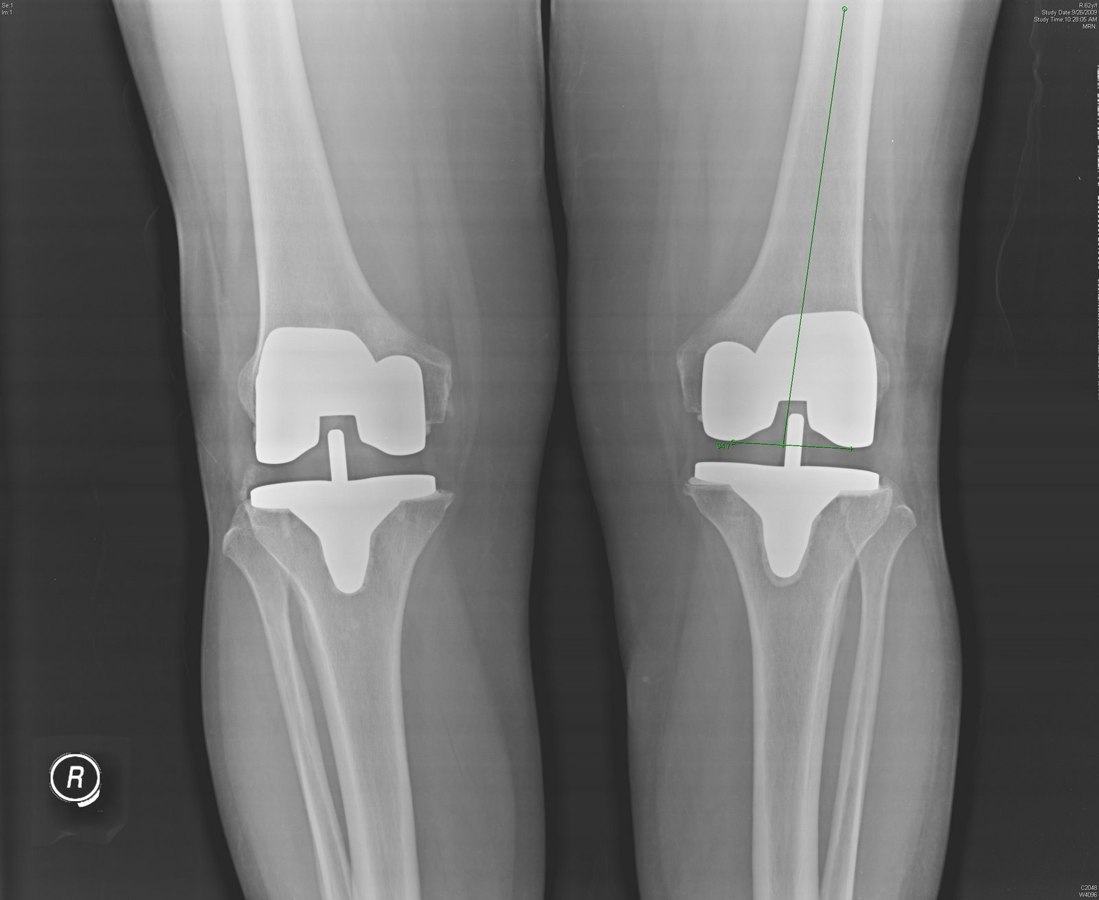 joint care foundation Bilateral Knee Joint Replacement