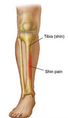 Shorey: Anatomy of a Shin Splint