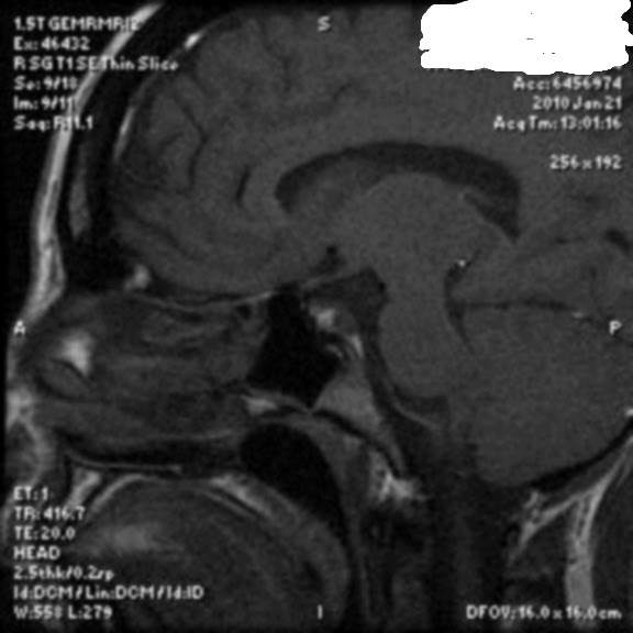 Team Tracy MRIs before and after
