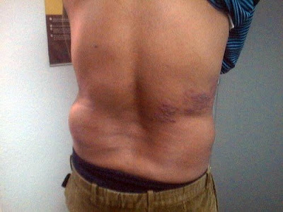 herpes sur le dos, herpes dos homme
