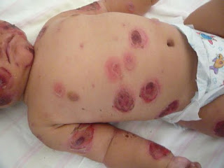 herpes zoster bébé