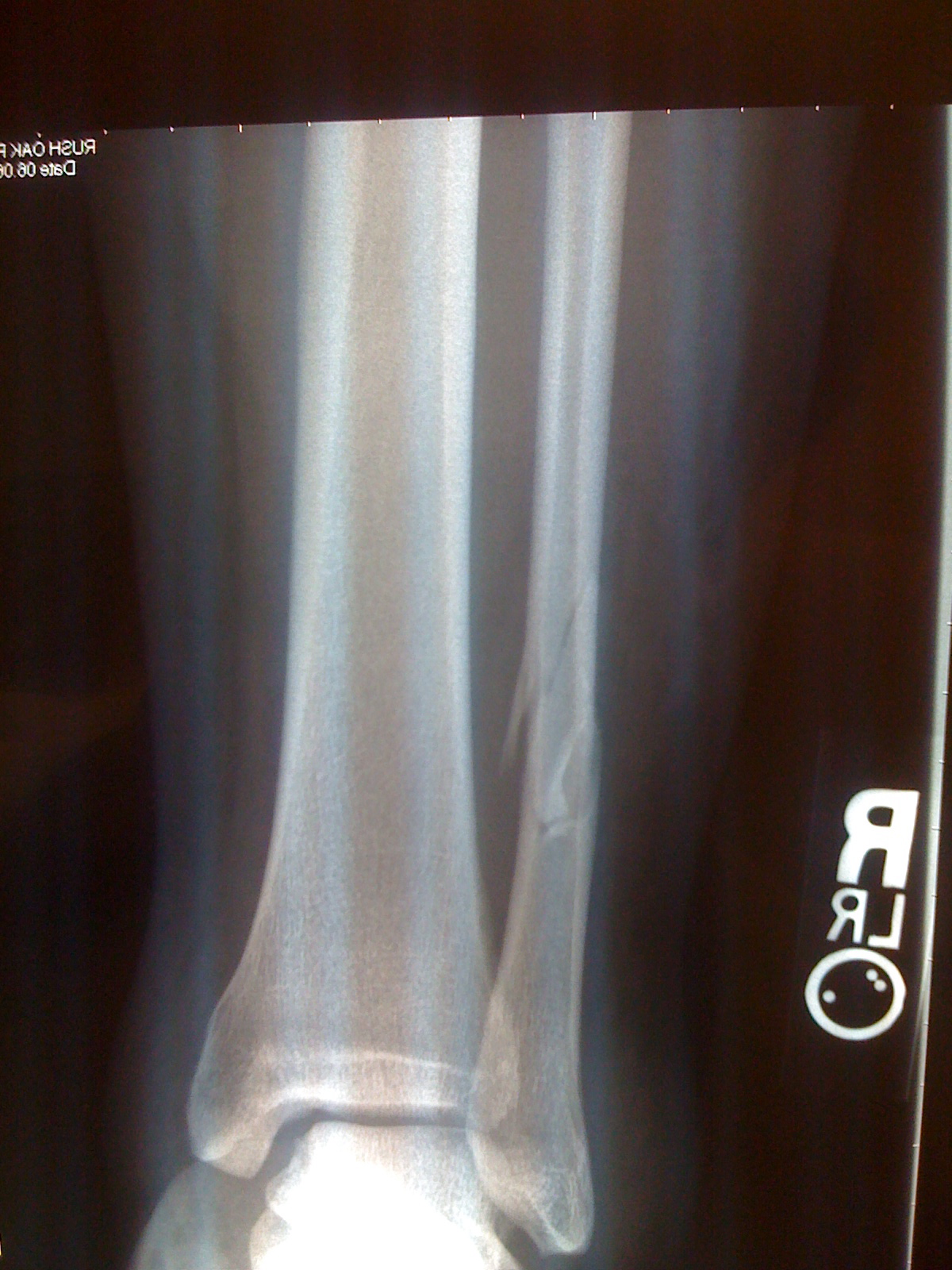 Fracture Healing Process-4.bp.blogspot.com Cleveland Foot and Ankle Case Blog