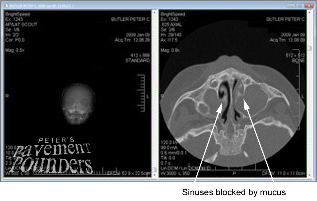 Ct+scan+sinus