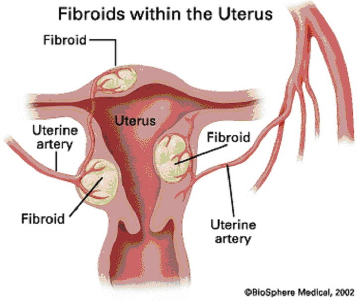 News from the Chinese Acupuncture Clinic Uterine Fibroids & Chinese