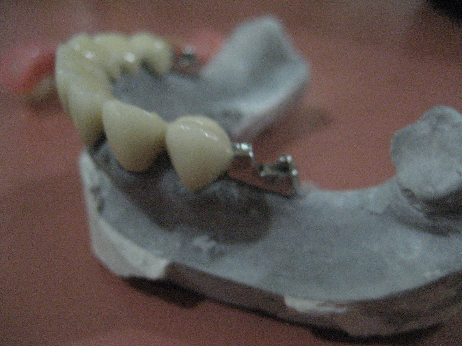 alternate to implants precision attachments