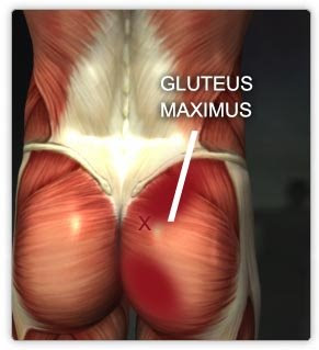 Glute Injection Site