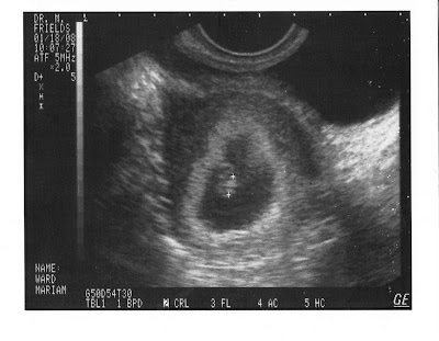 Ultrasound pic 12 Weeks (looks 12 5 week ultrasound. Ultrasound pic 12 Weeks (looks