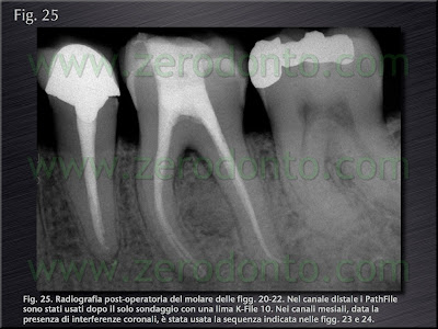 endodonzia castellucci endodonzia castellucci