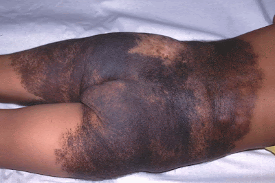 congenital%2Bmelanocytic%2Bnevus3.gif
