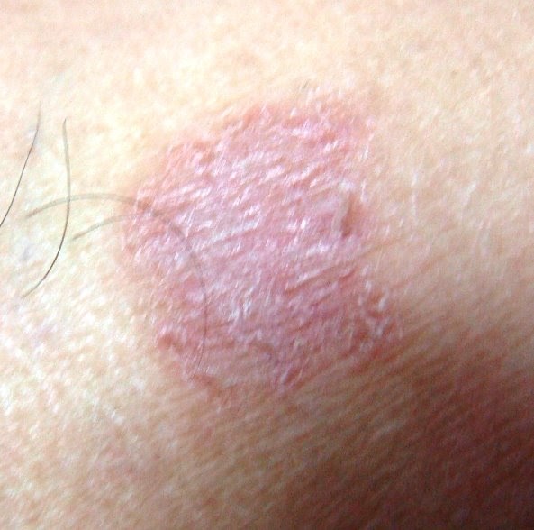 Skin Care Tips From Dermatologist How to Treat Eczema