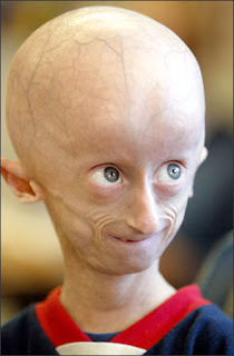 Niño con progeria