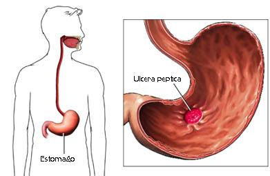 Nursing Interventions for Gastritis