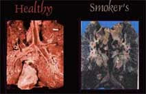 Healthy vs Smoker's Lungs
