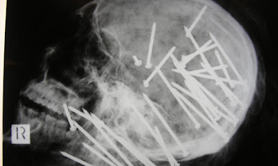 An x-ray showing around 30 nails piercing a skull has been released by