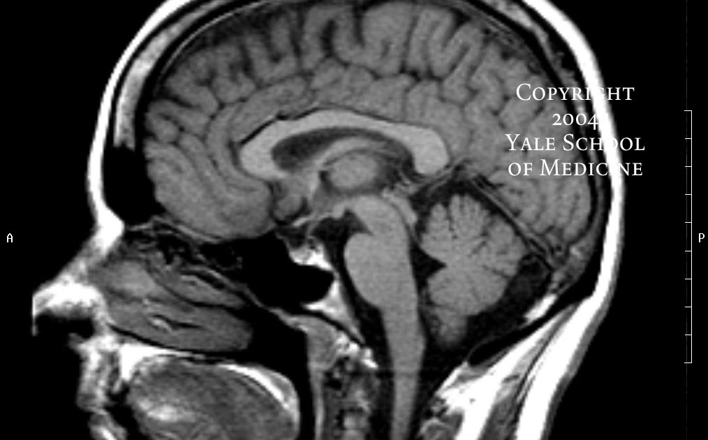 Mafer's Blog: MRI -the future of mind reading-