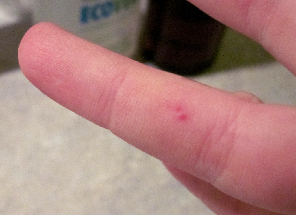 Wasp Sting Image