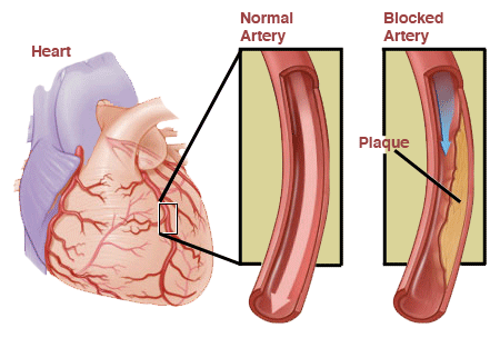 What Is The Medical Definition For Angina Pectoris