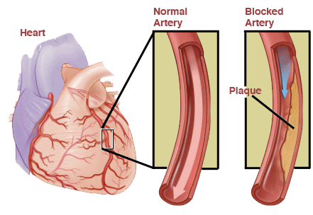 Variant Angina Pectoris