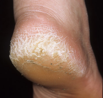 About cracked heels and some