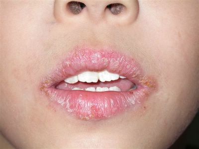 Treat Angular Cheilitis Naturally Treat Angular Cheilitis Naturally