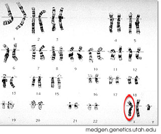 Klinefelter syndrome