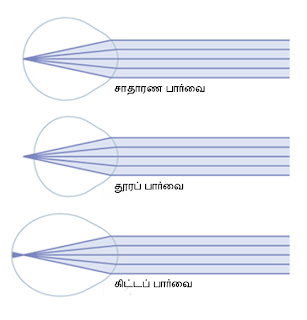 கண் - Anatomy  Refractive+errors