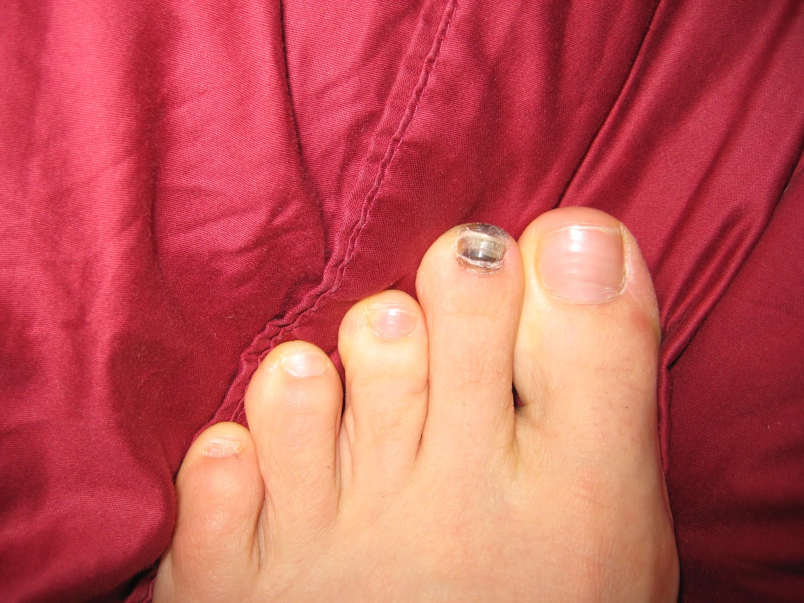 East and West Running Treadmill Toes and Underwear Ulcers....