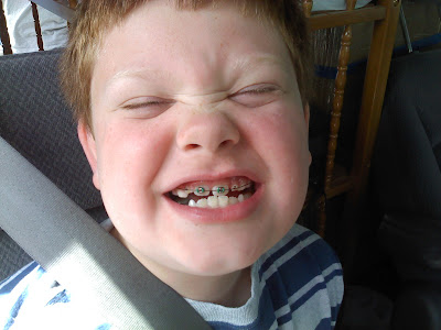 braces problems