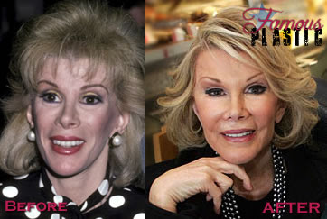 Joan Rivers Plastic Surgery on Joan Rivers Plastic Surgery Before And After Photos   Ready2beat