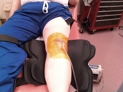 portable wound vac arrived
