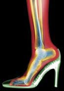 X-rayed foot in a stilletto, showing the person is basically standing on tiptoe
