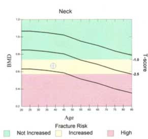 Graph showing green for good bone density, pink for osteoporosis, and yellow in the middle for osteopenia