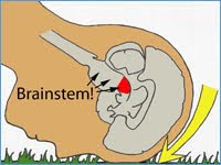 Schematic drawing of a head, with brain and brainstem highlighted, crashing into the ground