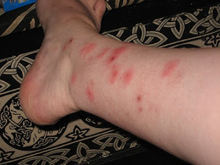 Bug bites