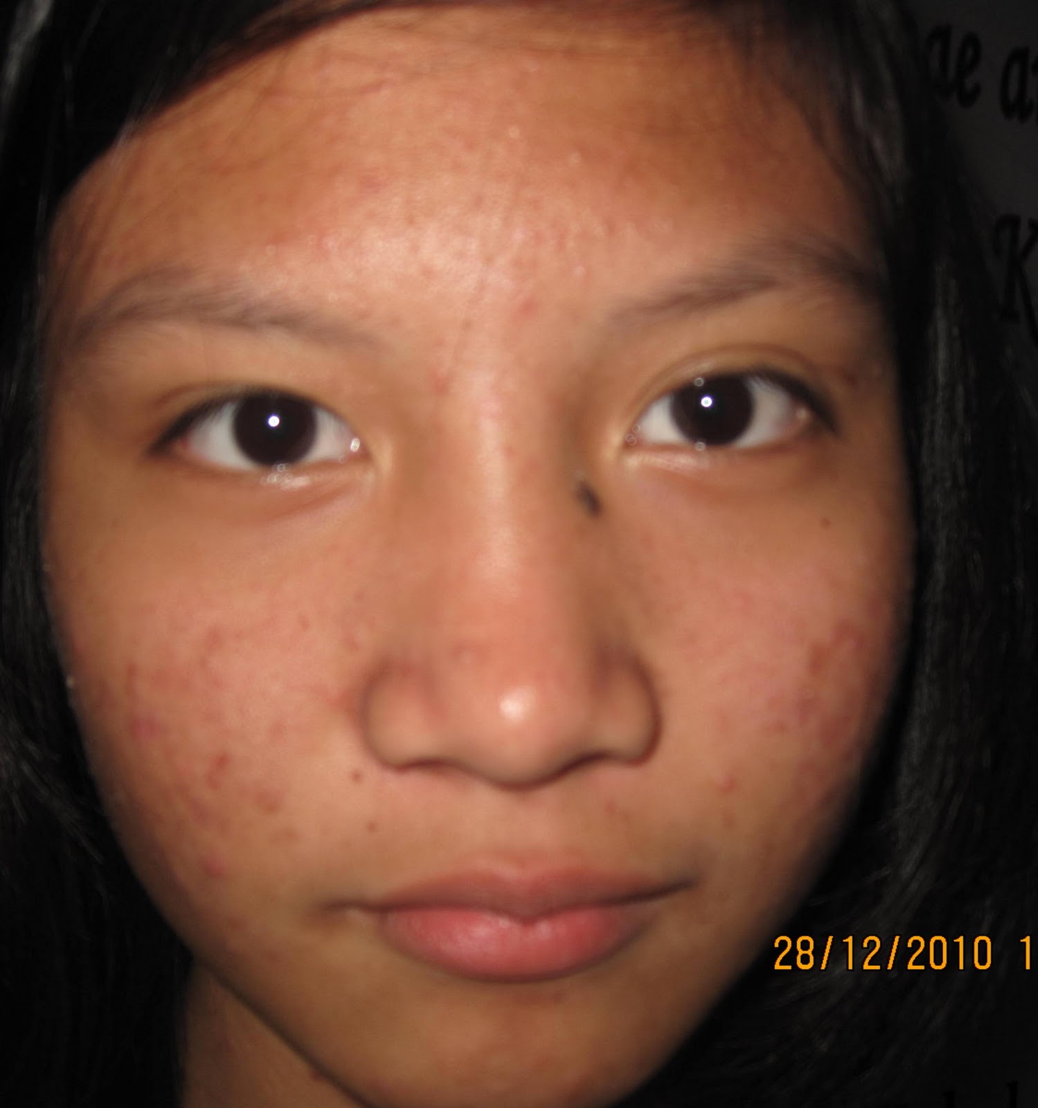 grade 3 acne