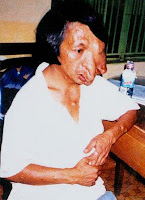 Vietnamese woman with horrendous dioxin deformities