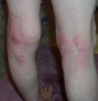 [Brody+eczema+legs.jpg]