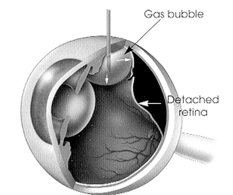 gas bubble detached retina gas bubble detached retina